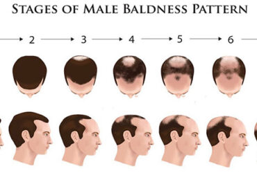 5 راهکار طبیعی ترمیم ریزش موی مردان