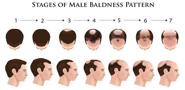 5 راهکار طبیعی ترمیم ریزش موی مردان